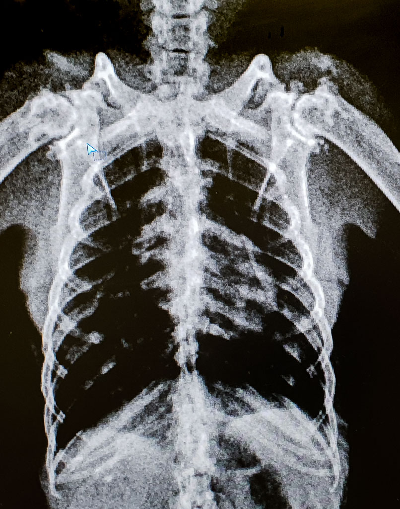 A chest xray of an old black Flying-x showing severe osteoarthritis of both shoulder joints.